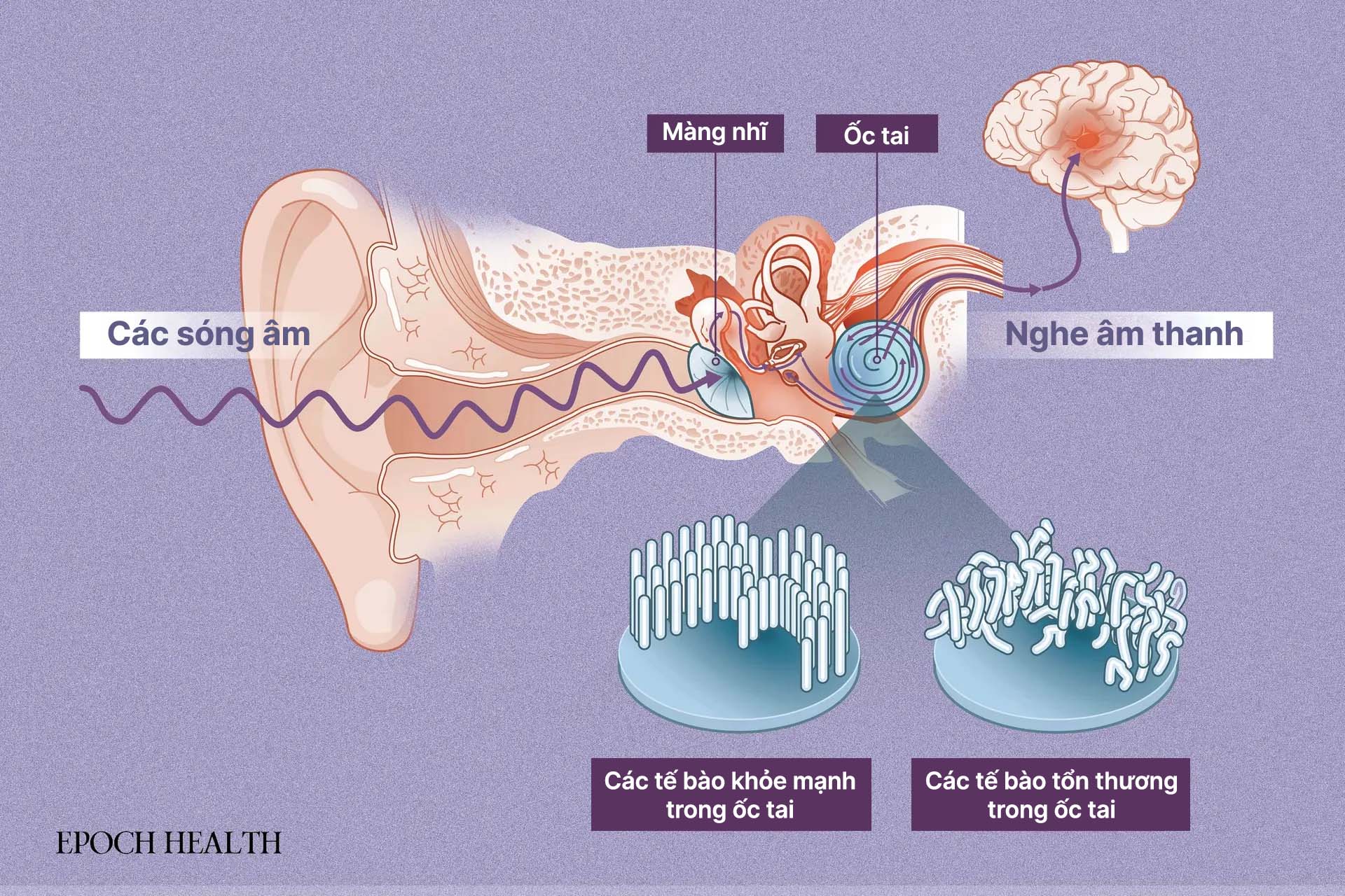 Ốc tai nằm phía sau màng nhĩ, biến sóng âm thanh thành tín hiệu điện để truyền đến não. (Ảnh: The Epoch Times, Shutterstock)