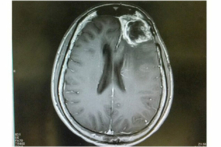 Hình ảnh khối u nguyên bào thần kinh đệm trên cộng hưởng từ. (Ảnh: ShutterStock)