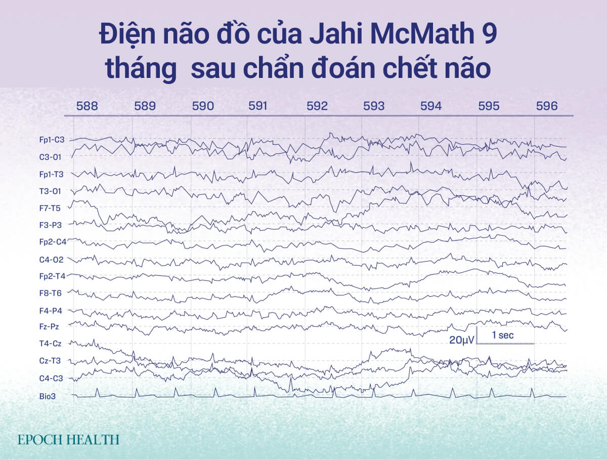 Điện não đồ của Jahi McMath, người được tuyên bố là chết não, lẽ ra không có hoạt động gì. (Ảnh minh họa bởi The Epoch Times)