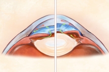 Bệnh tăng nhãn áp là nguyên nhân gây mù lòa thứ hai sau đục thủy tinh thể. (Ảnh: Minh họa bởi The Epoch Times)