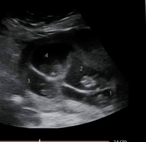 Hình ảnh siêu âm của cô Vancamp-Smith trong thai kỳ sinh tư. (Ảnh: SWNS).